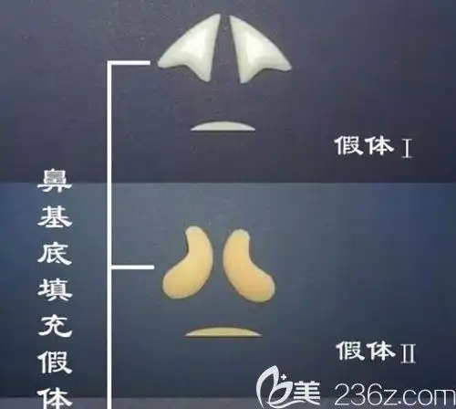 选用膨体立秀垫鼻基底后会出现反复肿胀导致鼻翼变宽变大么?