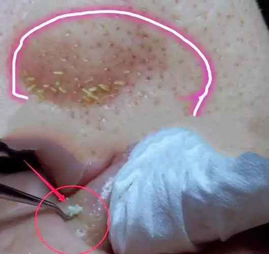 因为它们就是皮肤分泌的脂肪,油脂类的物质,积累在毛孔里形成的脂栓