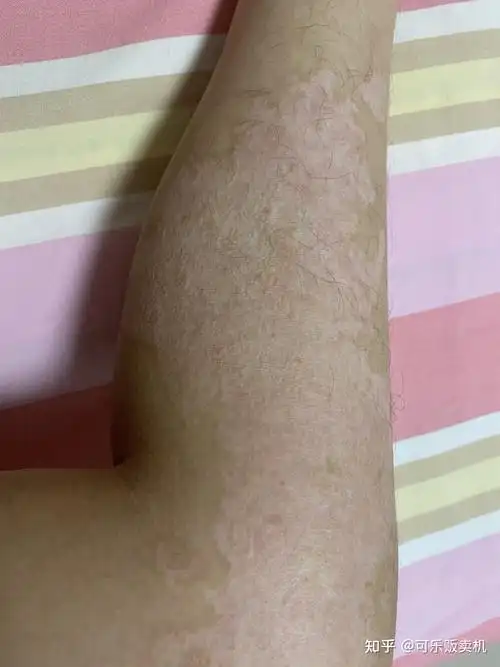 浅二度到深二度烧伤恢复过程记录有图慎点