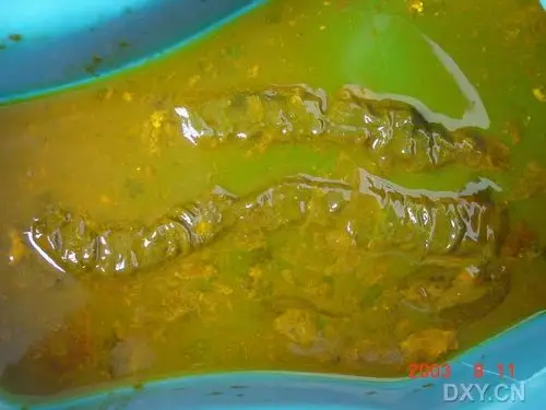 【共享】经典伪膜--伪膜性肠炎图片