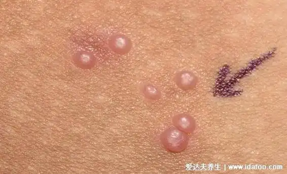 男性得性疾病后八大症状图片,警惕梅毒/生殖器疱疹/尖锐湿疣