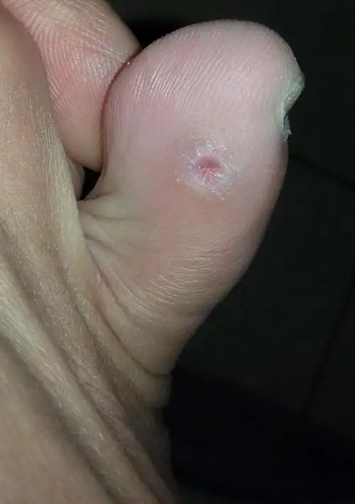 左脚右脚小指内侧长了鸡眼(如图),用过鸡眼贴,现在又复发了,很恼