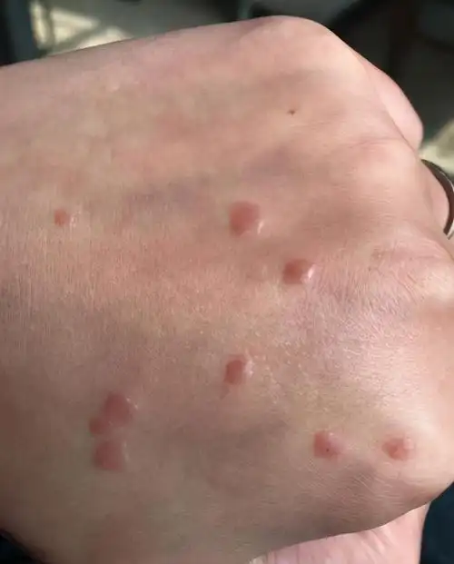 瘊子,就是hpv病毒(也就是人乳头瘤状病毒)感染之后导致的增生性疾病.