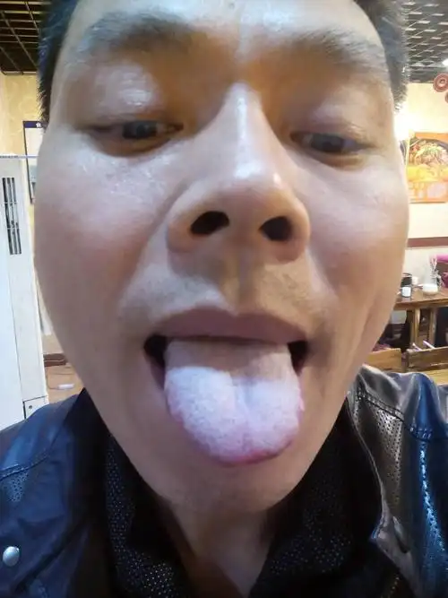 胃病20多年了,半年前胃镜显示胆汁返流性胃炎,食管裂孔疝,想吃点中成