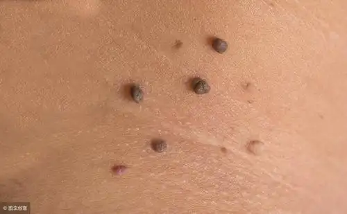 黑色素细胞瘤可由表皮黑色素细胞,痣细胞或真皮成黑色素细胞组成,肿瘤