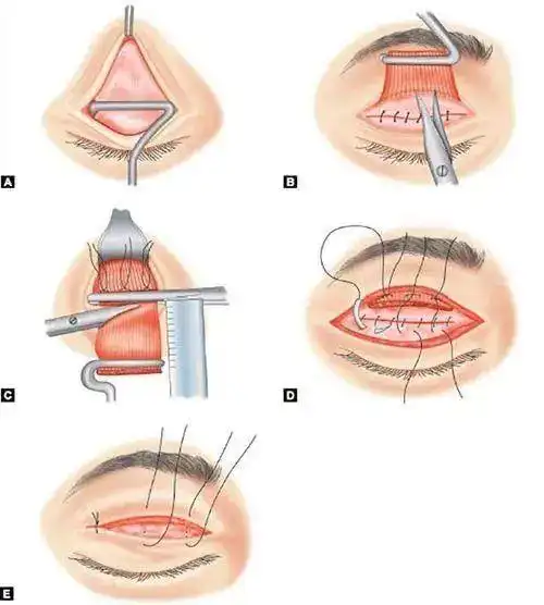 为提上睑肌发育异常,或者支配它的神经发育不良),眼部外伤,眼部手术