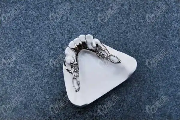 纯钛活动牙套价格多少