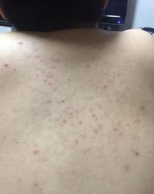 螨虫堵塞后背毛孔,最明显表现是痘痘疯长,来学3招除螨又祛痘_毛囊