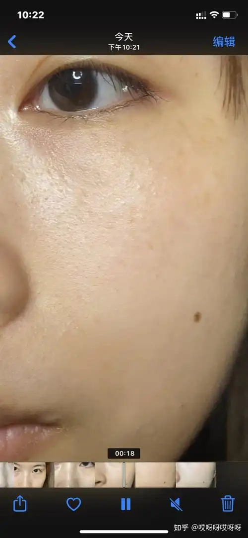 脸颊的这个是什么皮肤问题