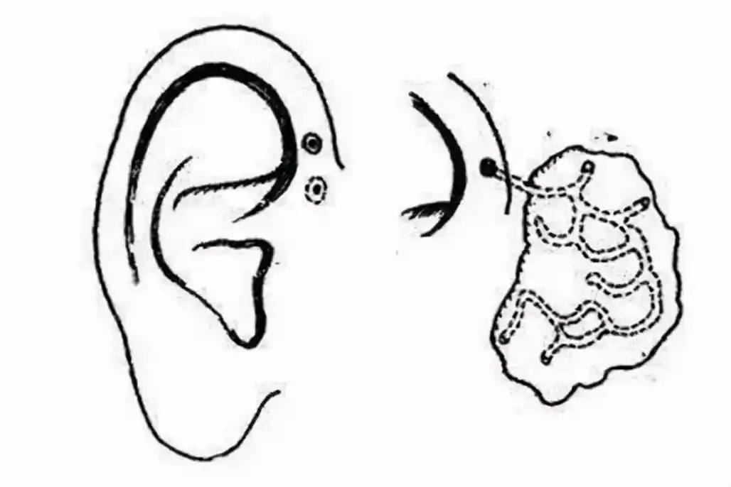 耳朵前面的小洞是怎么回事?一文读懂耳前瘘管