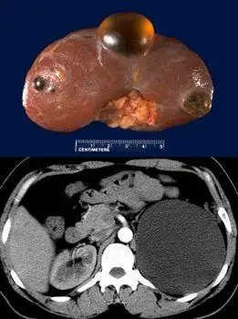 肾病专家解读:多囊肾是怎么形成的?