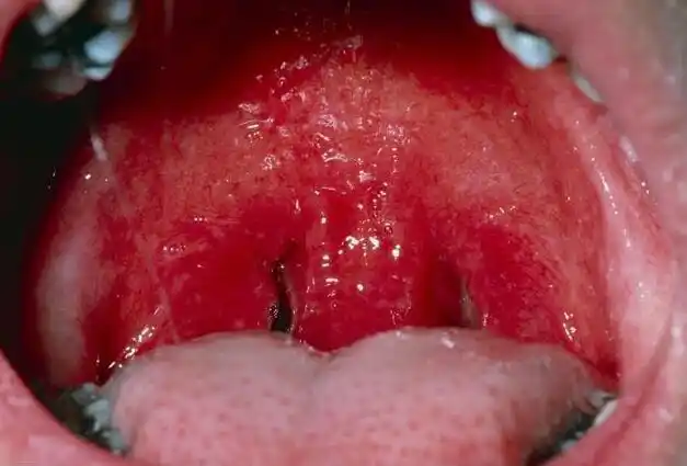 慢性的充血,主要是暗红色的,充血,水肿不明显.