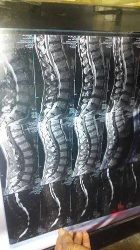 这是我爸在医院拍的片子,骨质增生,腰椎盘突出,有医生说做手术有一定