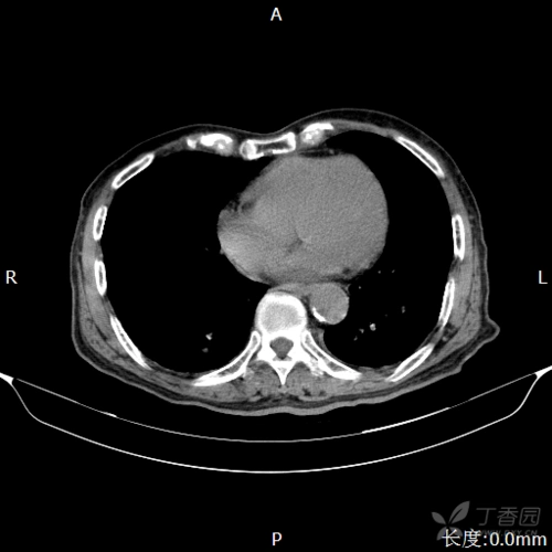 肠系膜扭转,肠梗阻.