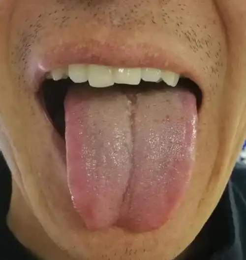 肝火旺盛——看舌边,看舌边