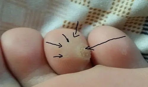 图解跖疣鸡眼和胼胝三者区别