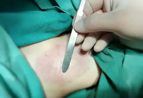 治疗腋臭我们是认真的深圳中海医院联手天方腋谭医生集团服务深圳市民