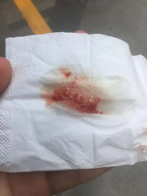 患者术后咳血常呈现下列照片表现.