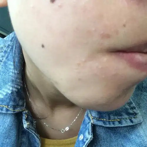 怎么治疗封闭性粉刺有什么方法-学路网-学习路上 有我相伴