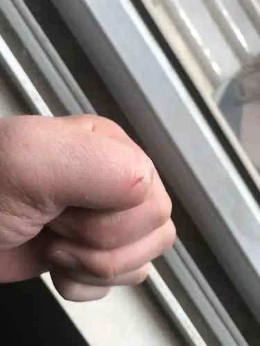 被不锈钢割破手指