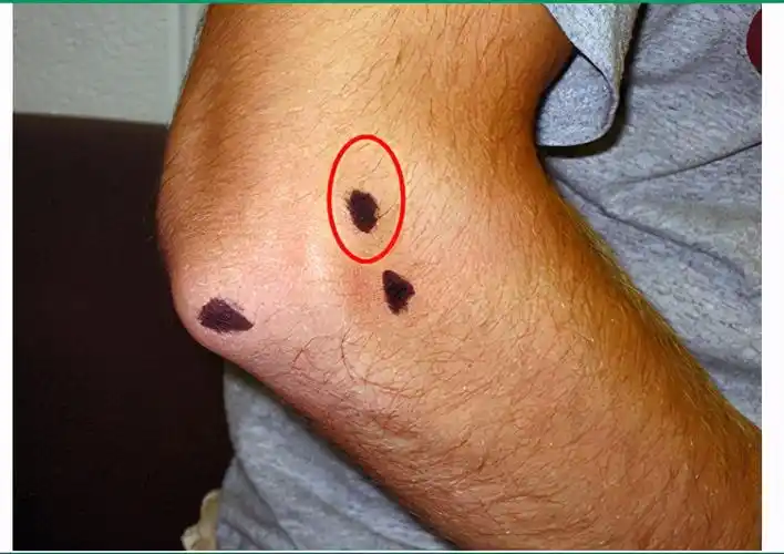 咋治早期的网球肘(路大夫,我从没打过网球,为什么会得「网球肘」?