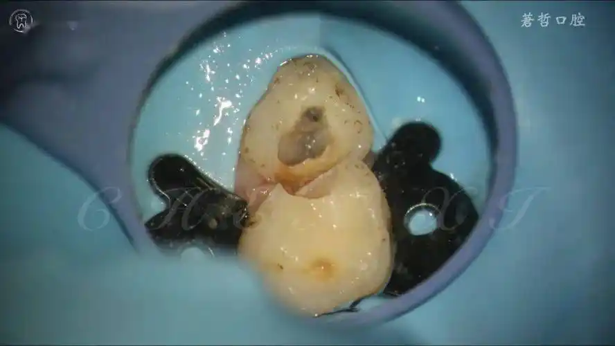 值得收藏的乳磨牙的根管治疗…_显微镜_侧根_乳牙