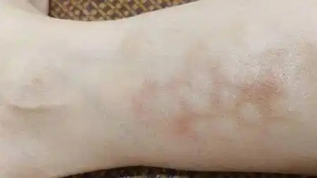 艾灸后皮肤出现淡浅红斑是我身体有问题吗