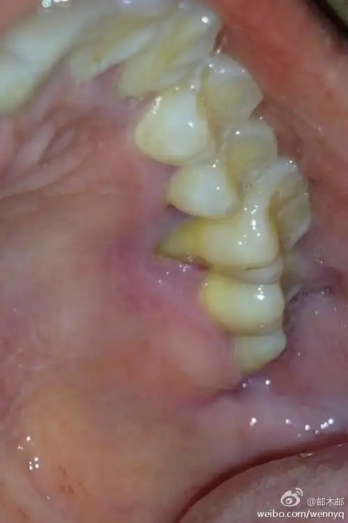 左上牙牙龈萎缩,特