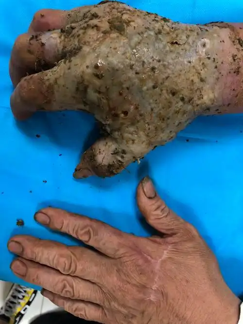 毒蛇咬伤,规范救治 - 好大夫在线