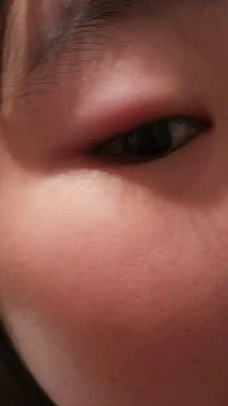 问:眼睛肿起来了,而且很痛,怎么办?