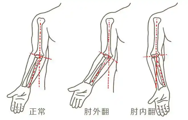 骨折|肘外翻|肌肉|肘部_网易新闻