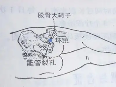 中医推拿梨状肌综合征