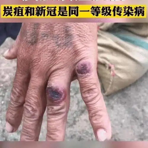 因此在我国规定了炭疽病人必须进行隔离治疗. 炭疽的症状 随感染方式