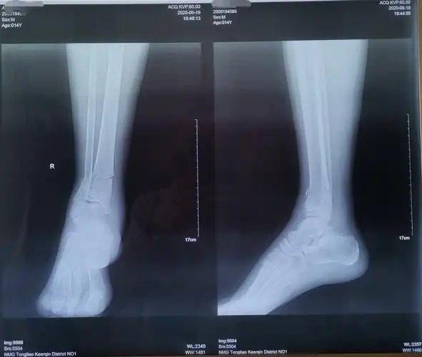 14岁胫腓骨远端骨折闭合复位外固定架固定手术一例