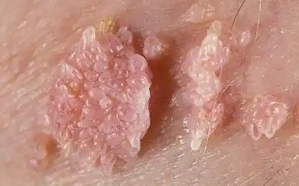 疣_介绍_症状表现 - 好大夫在线