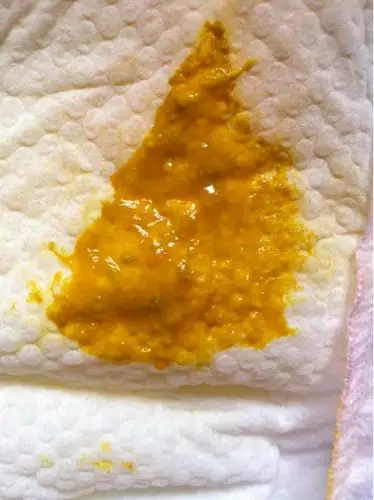 昨天是水样稀稀的,之后昨天吃了蒙脱石散还是拉这样的便便_百度宝宝