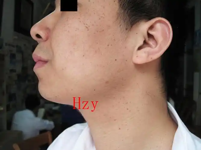 公布答案:脂溢性角化病.