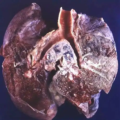 小细胞肺癌晚期怎么办