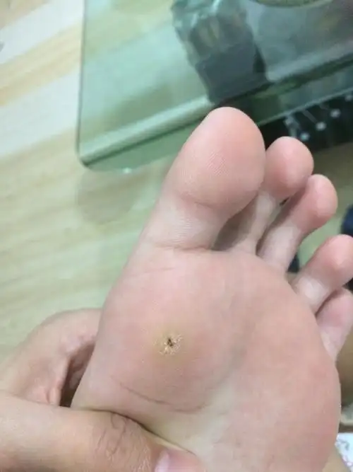 鸡眼昨天扣了扣,昨天扣的看到里面的丁点红肉了有点疼就没扣,今天变黑