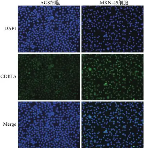 cdkl5 在胃癌中的表达及其临床意义