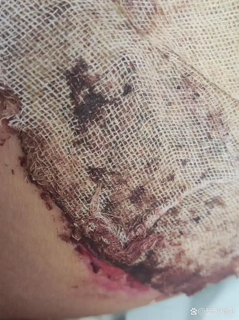 植皮术后79天,我该怎么办…… 取皮区越来越差了,好的地方都破了,现在