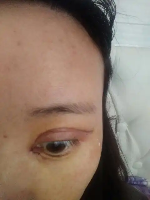 开眼角第三天,发炎是什么样的?