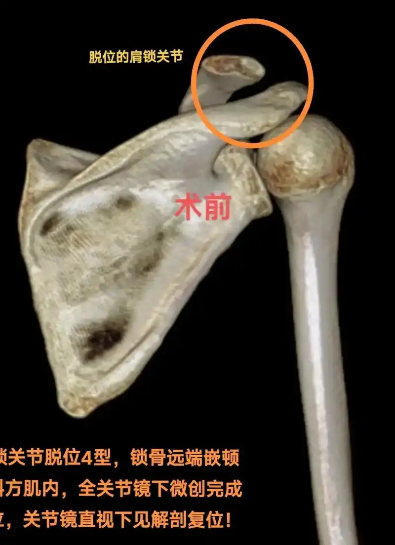 全关节镜微创下完成肩锁关节脱位! - 抖音