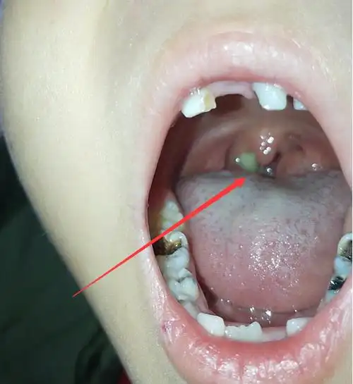 宝宝扁桃体经常发炎是什么原因