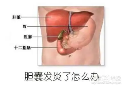 胆囊炎治疗方法的介绍