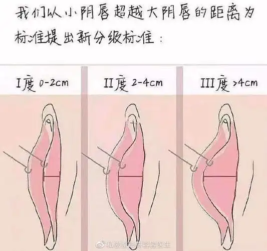 女性小阴唇有真正的标准美观吗?