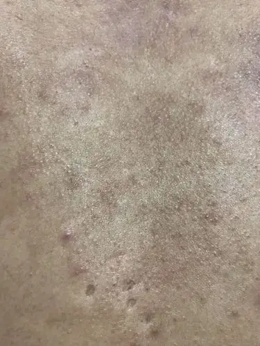 皮肤病 背上和胸口.