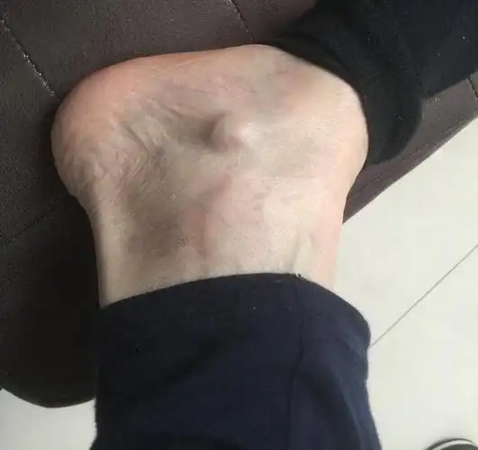 手术前足踝关节腱鞘囊肿照片