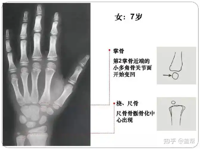 骨龄几岁还能长高吗女孩篇