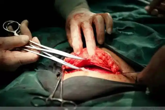 剖腹产手术都半麻,会不会看着医生剖肚子太残忍?